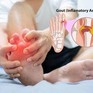 7 Buah dan Tanaman Alami yang Ampuh Menurunkan Asam Urat