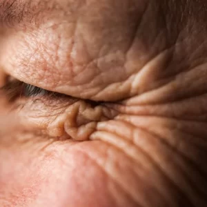 Cara Alami Menghilangkan Kerutan di Bawah Mata