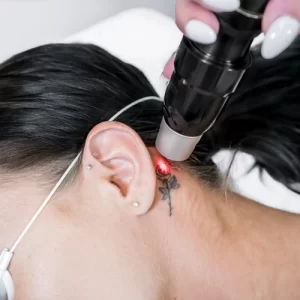 Tato Menyesal? Ini Cara Aman Menghilangkannya Secara Permanen