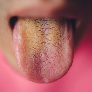 Waspada Lidah Kuning! 7 Penyebabnya Bisa dari Rokok hingga Penyakit Serius
