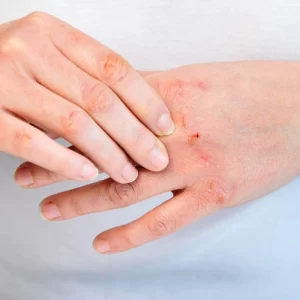 Alergi: Penyebab, Gejala Umum & Cara Mengobatinya